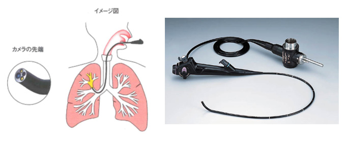 気管支鏡(肺カメラ)検査