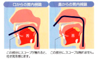 経口内視鏡と経鼻内視鏡