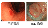 上部消化管内視鏡の治療方法