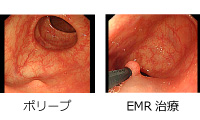 大腸内視鏡の治療方法